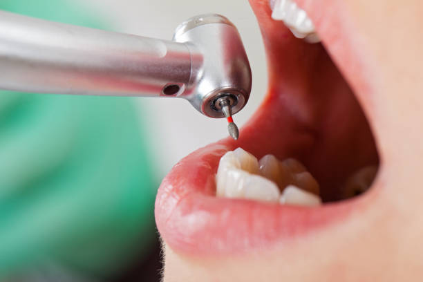 Best Emergency Dentist for Lost Fillings or Crowns in Beaver, UT